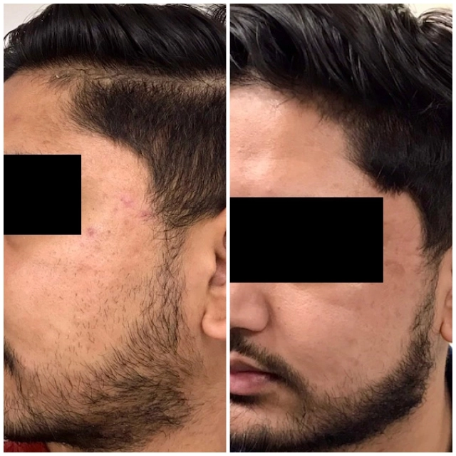 Acne and acne scar treatment 2