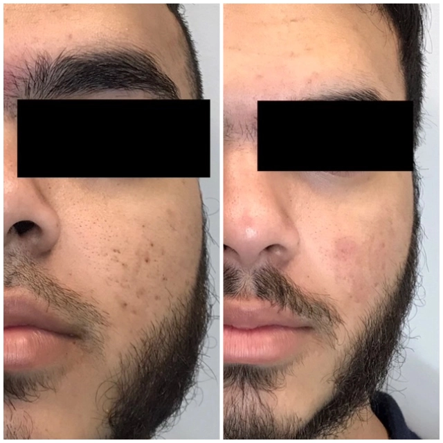 Acne and acne scar treatment