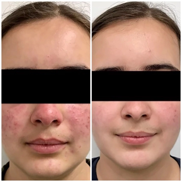 Acne treatment 2