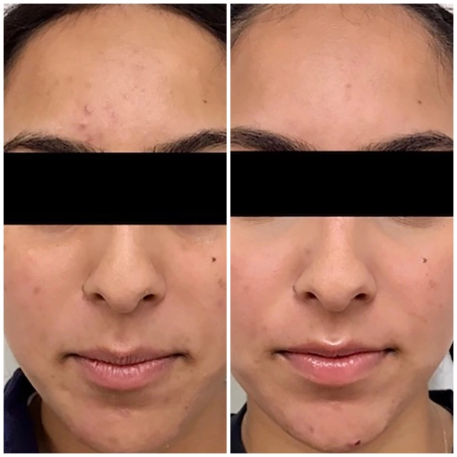 Acne treatment