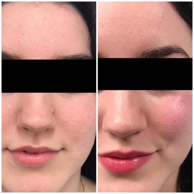 Benign lesion removal left nose