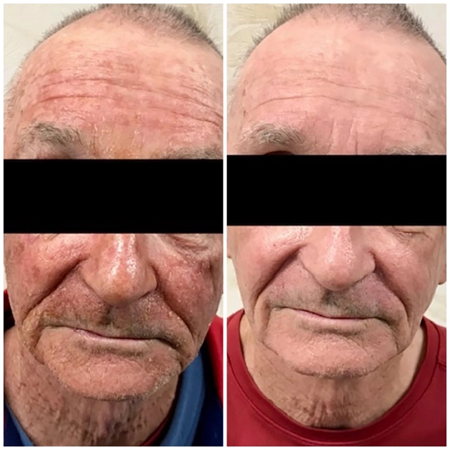 Photodynamic therapy 3