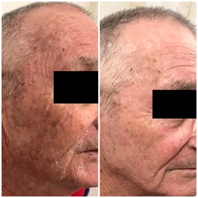 Photodynamic therapy 4