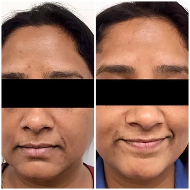 Pigment and Micro needling and rejuvenation