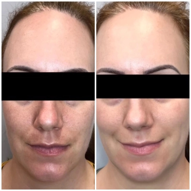 ErYag Laser micropeel