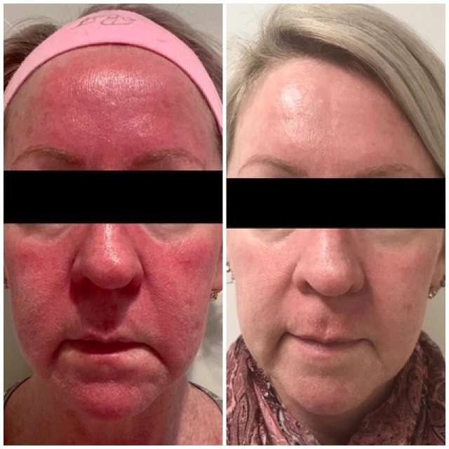 Photodynamic therapy 2