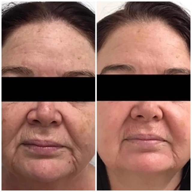 Photodynamic therapy