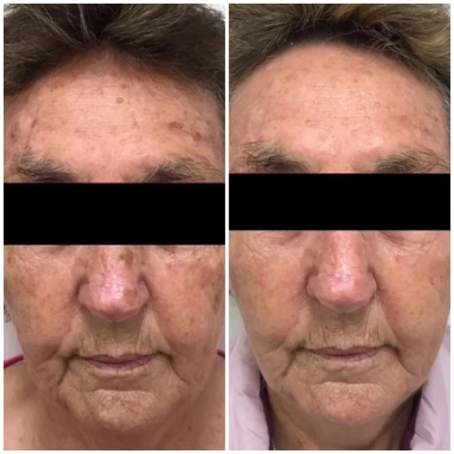 Pigment treatment, Rejuvenation and ErYag peel