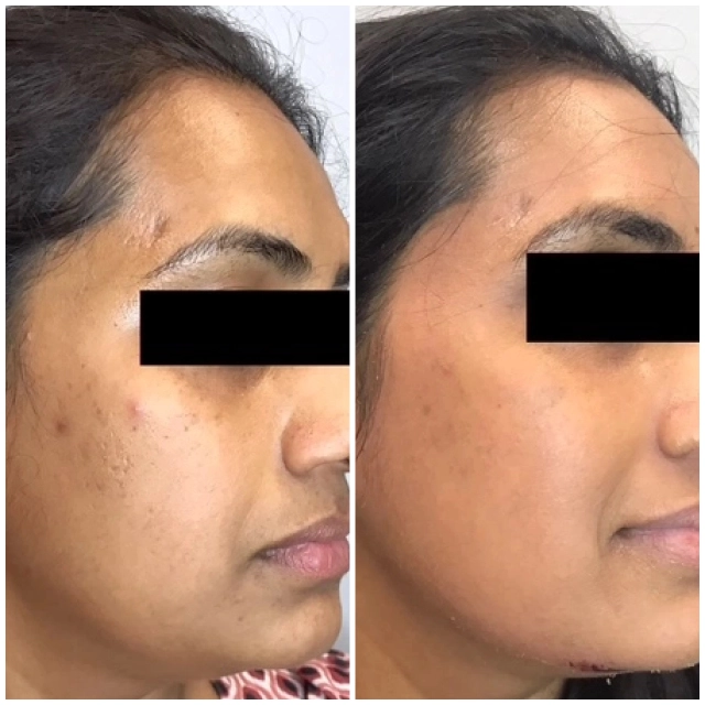 Pigment treatment