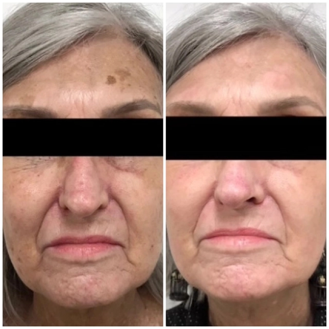 Rejuvenation and ErYag laser peel